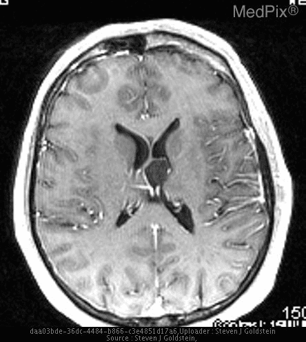 MRI image of a brain