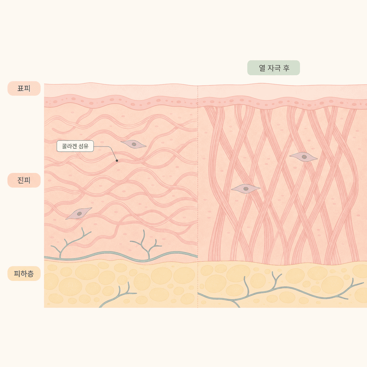 열 자극 이후 콜라겐이 재배열되는 과정을 단순화한 그림이에요.