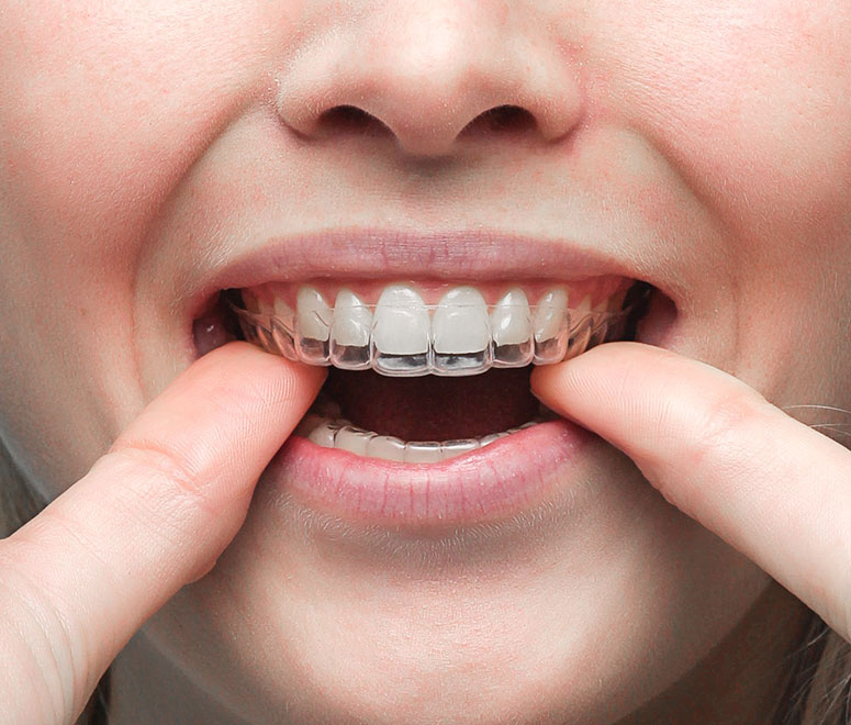 Een aligner om tanden en kiezen te corrigeren