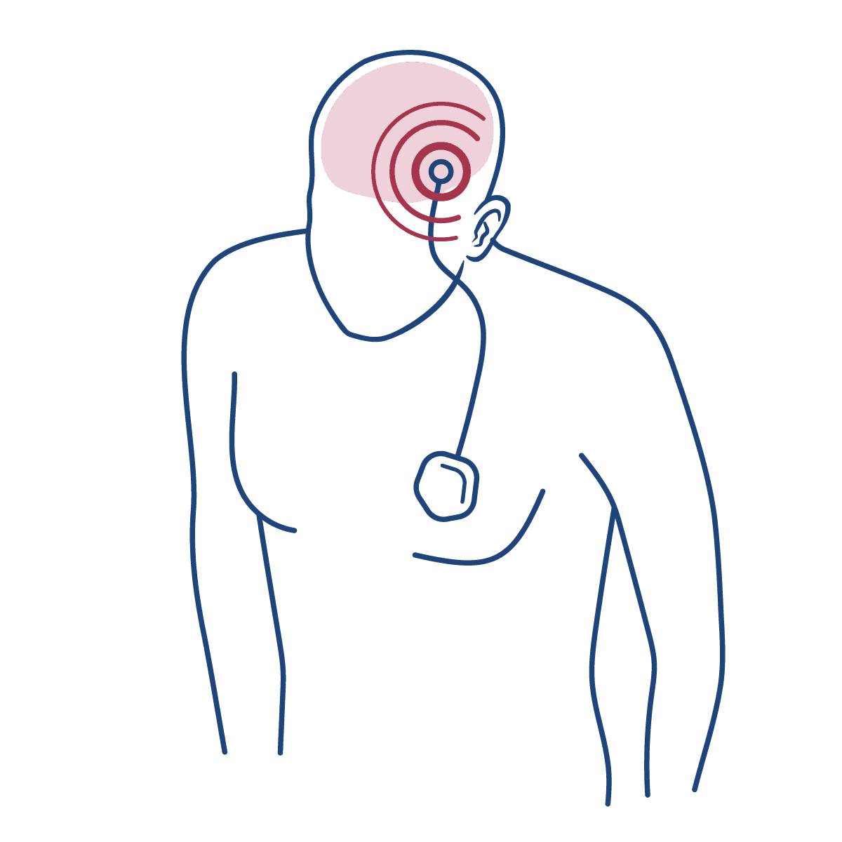 A imagem mostra um homem, desenhado em linhas azuis, com um implante de aparato para tratamento via estimulação cerebral profunda, para parkinson e tremor essencial.