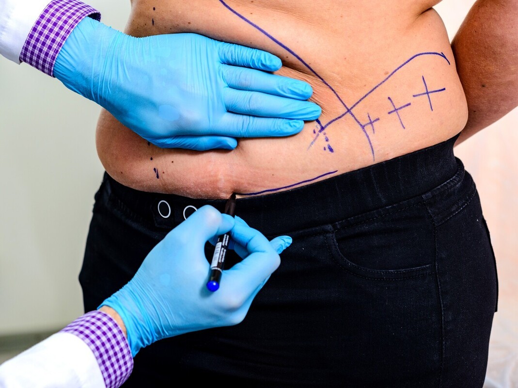 non invasive weight loss surgery