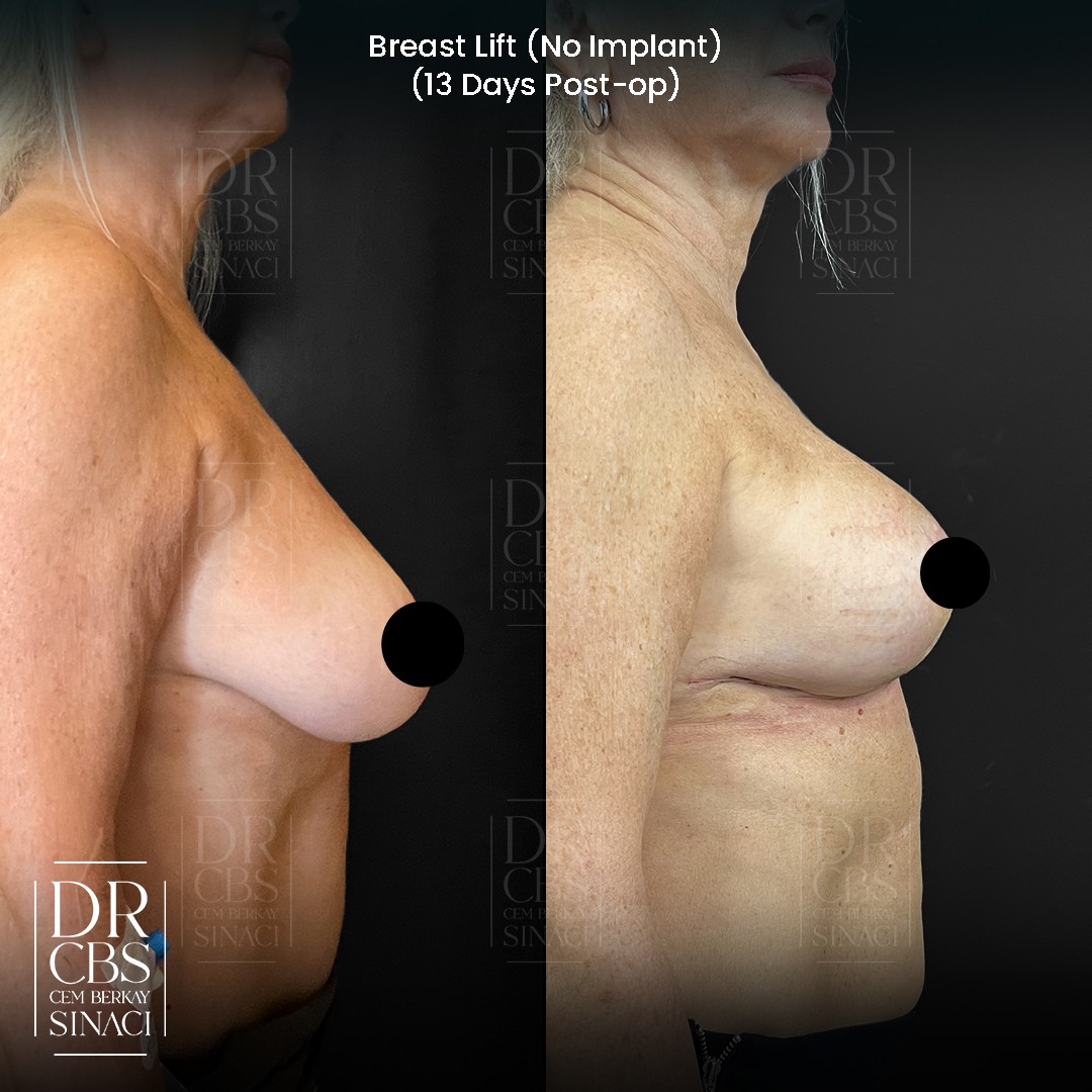 breast lift before after 13 days post-op no implant only auto augmentation side view