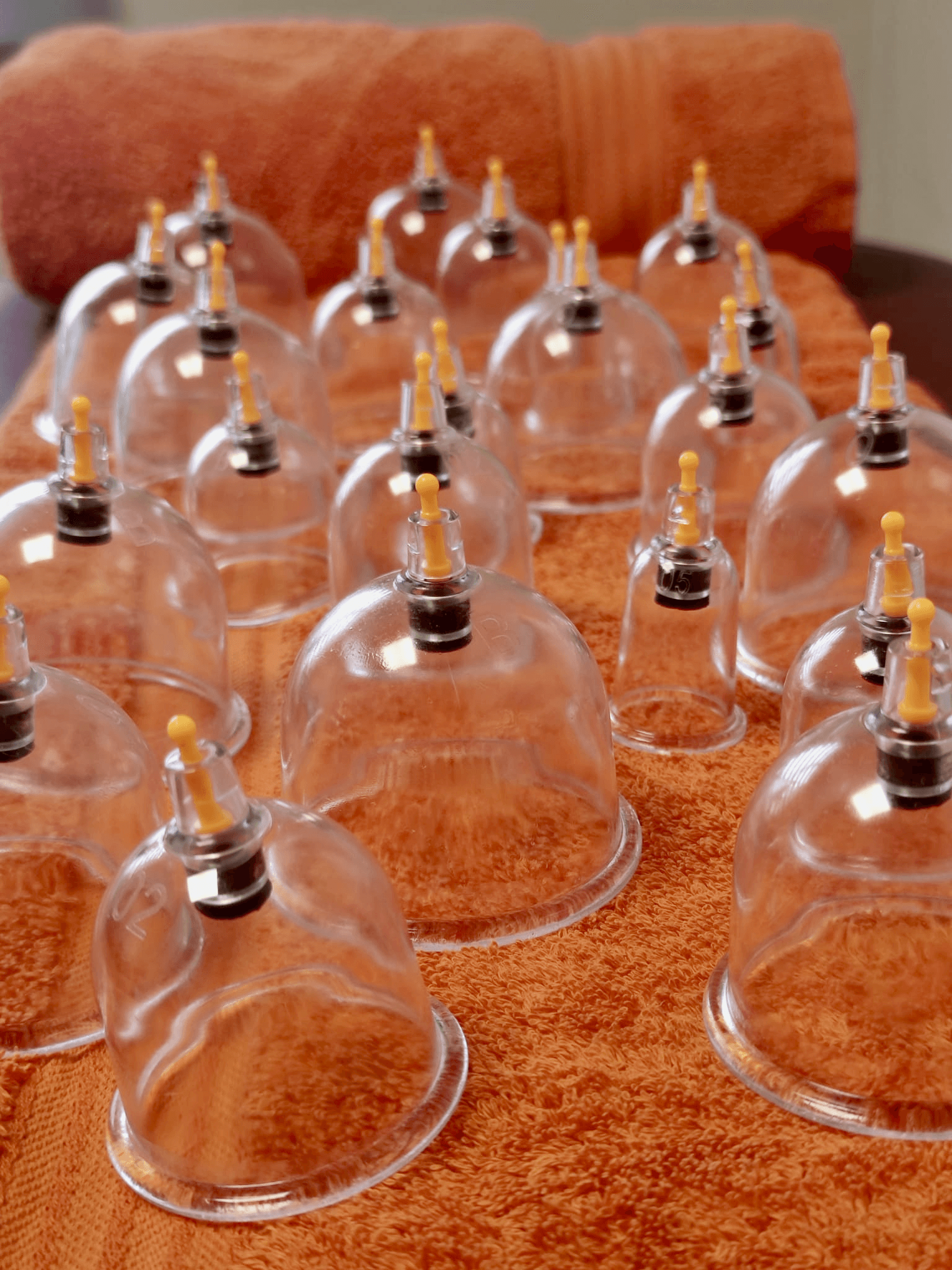 Cupping therapy treatment on a person's back. Multiple glass cups are placed on the upper back. 
