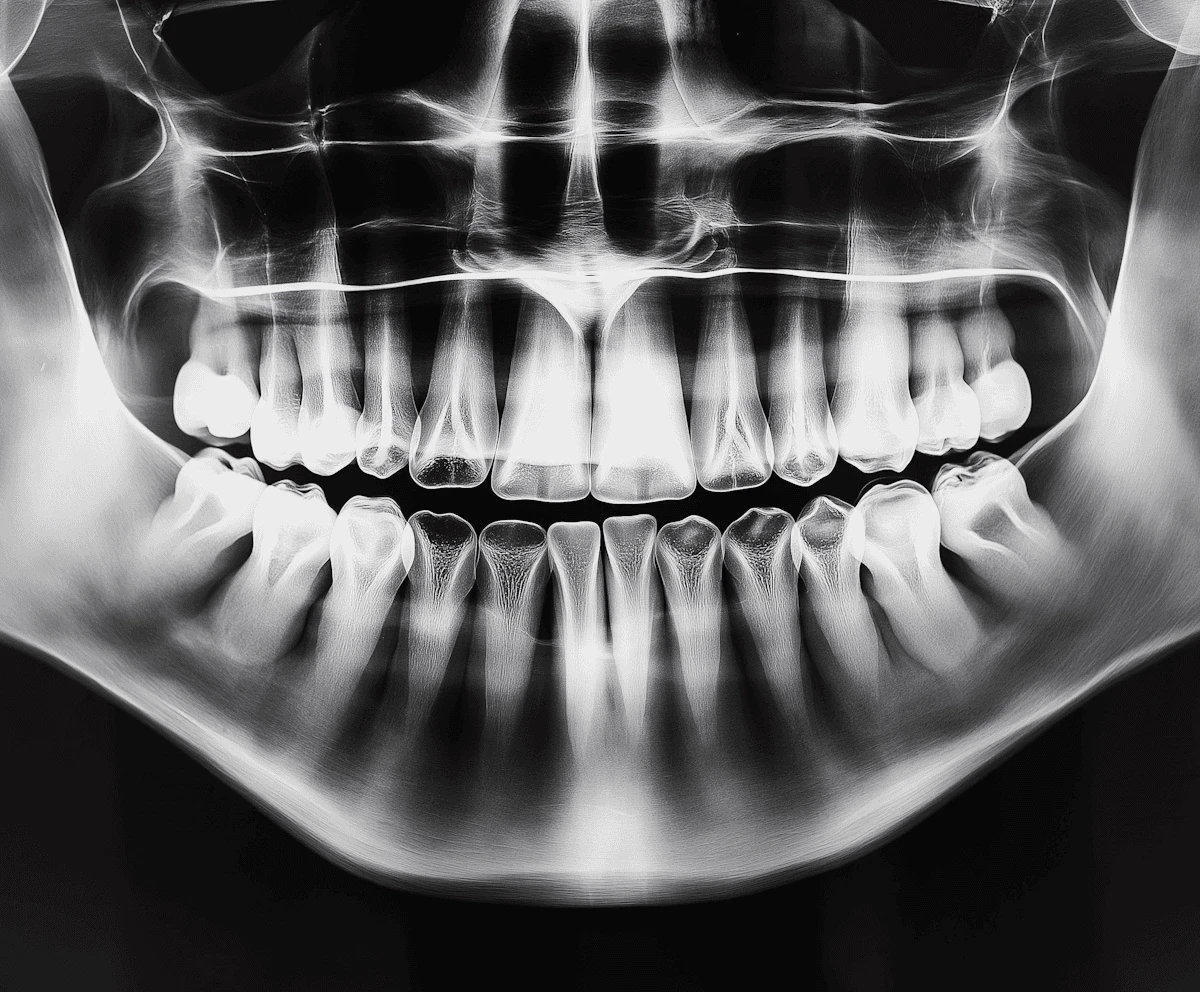 Dental X-Ray Photo | Bloor-Yorkville Periodontics