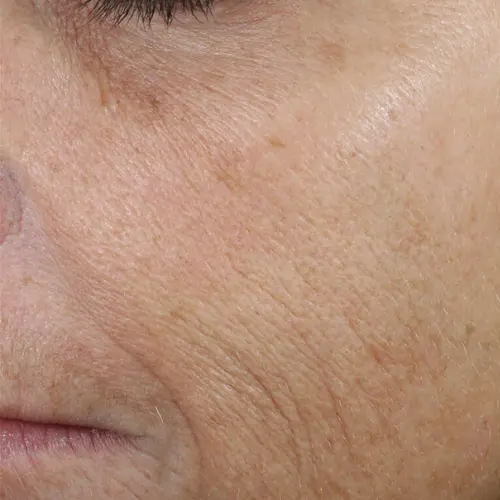 Before antioxidant treatment at The Vancouver Aesthetician — visible fine lines and wrinkles on cheeks and along smile lines with dull complexion