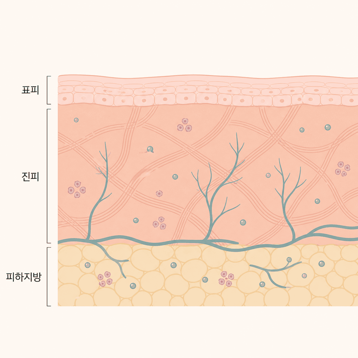 진피와 피하지방 사이에 남은 입자 주변으로 새 조직이 만들어지는 층