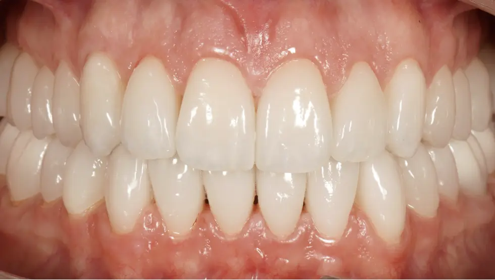 After prosthetic rehabilitation