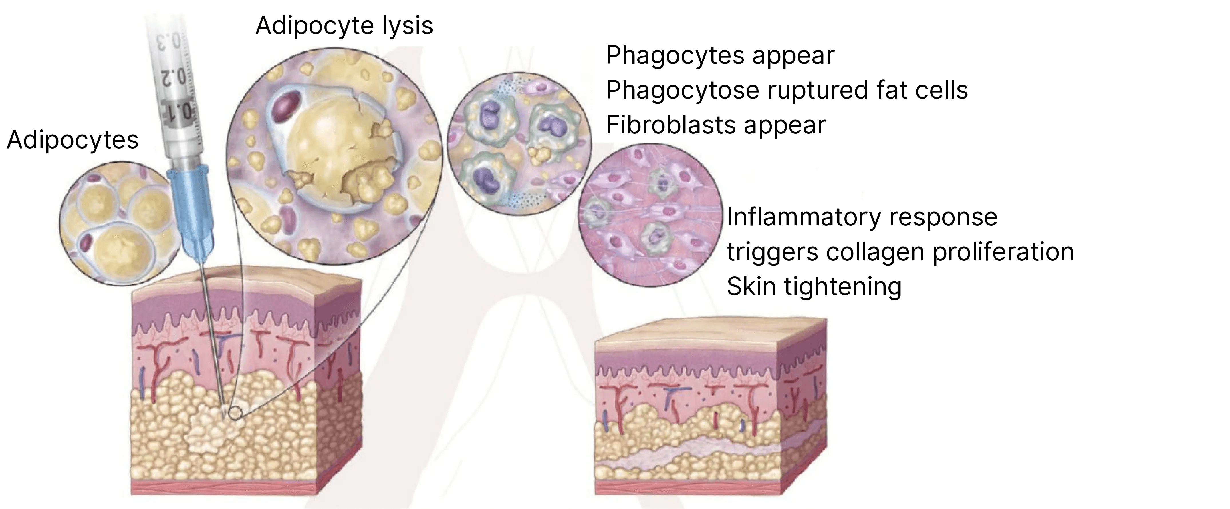 Deoxycholic Acid (DCA) Lipolysis Injection Layers