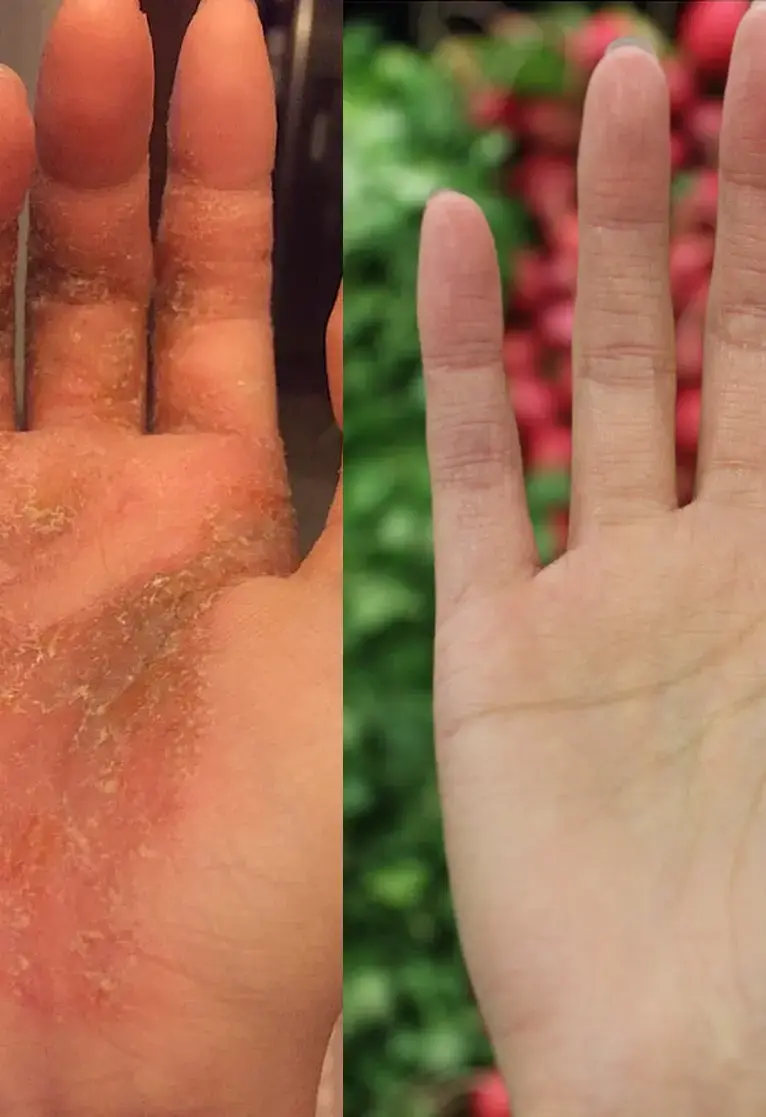 Before and after treatment - arm