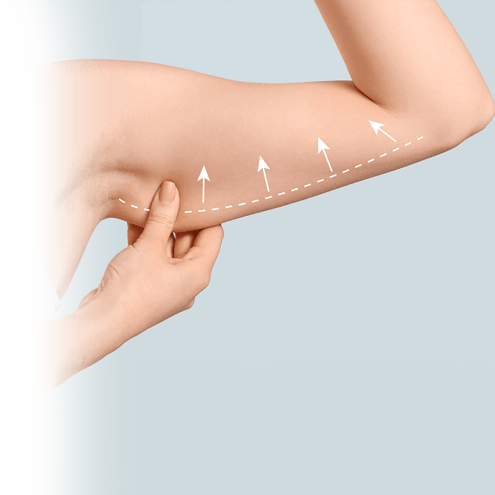 skin removal and incision placement of arm lift