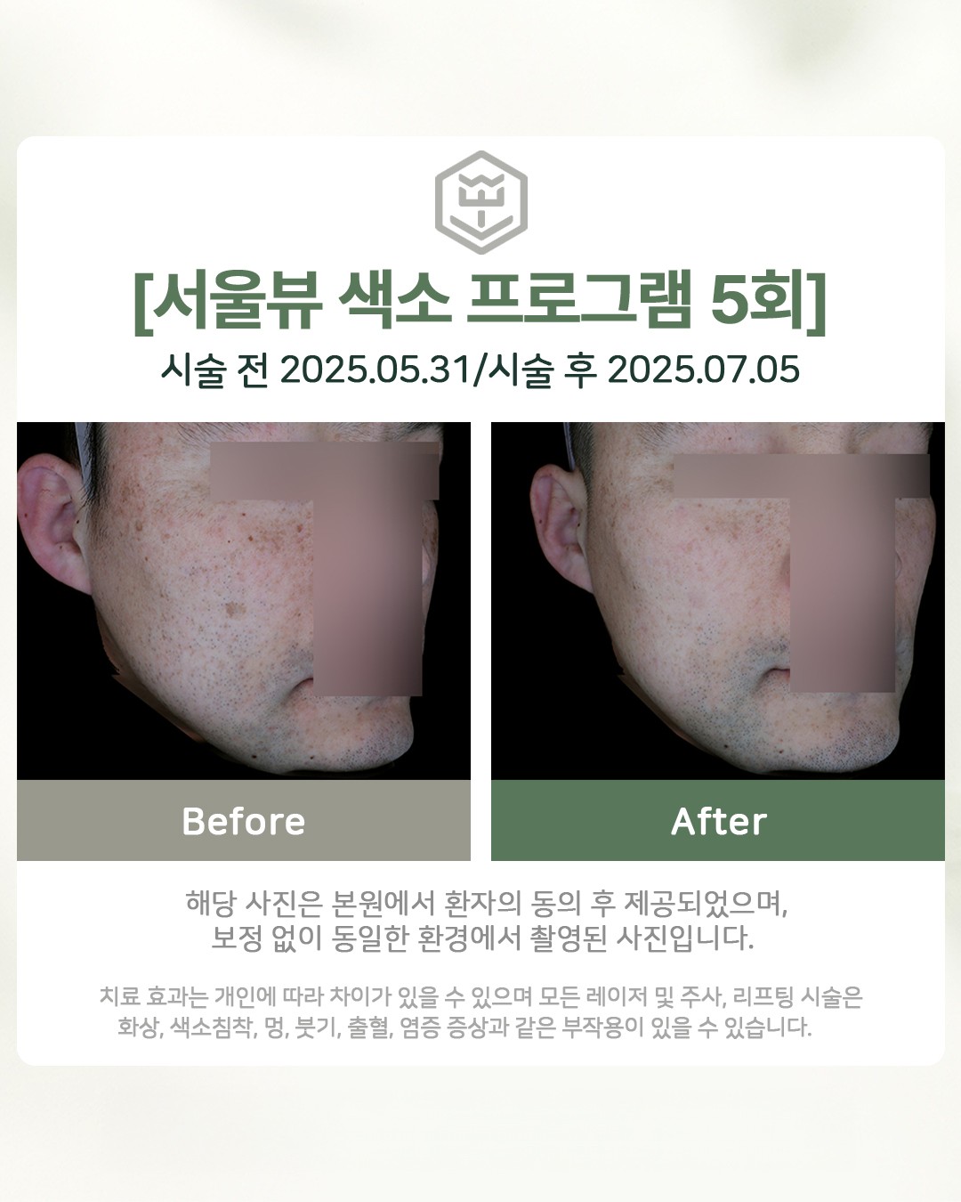 색소프로그램 5회