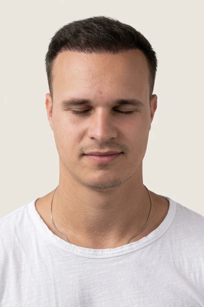 Natürliche Haarlinie und dichter Haaransatz nach der DHI Haartransplantation in Istanbul