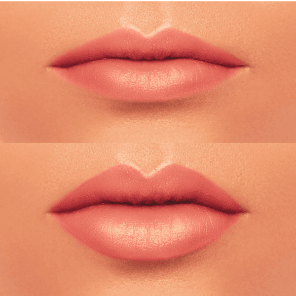 A closeup of lips before and after lip fillers