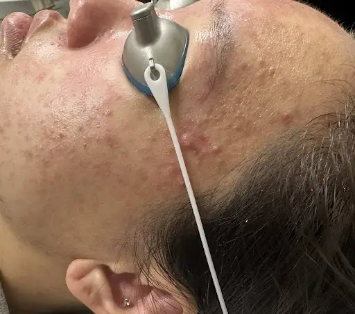 Patient receiving professional laser acne skin treatment.