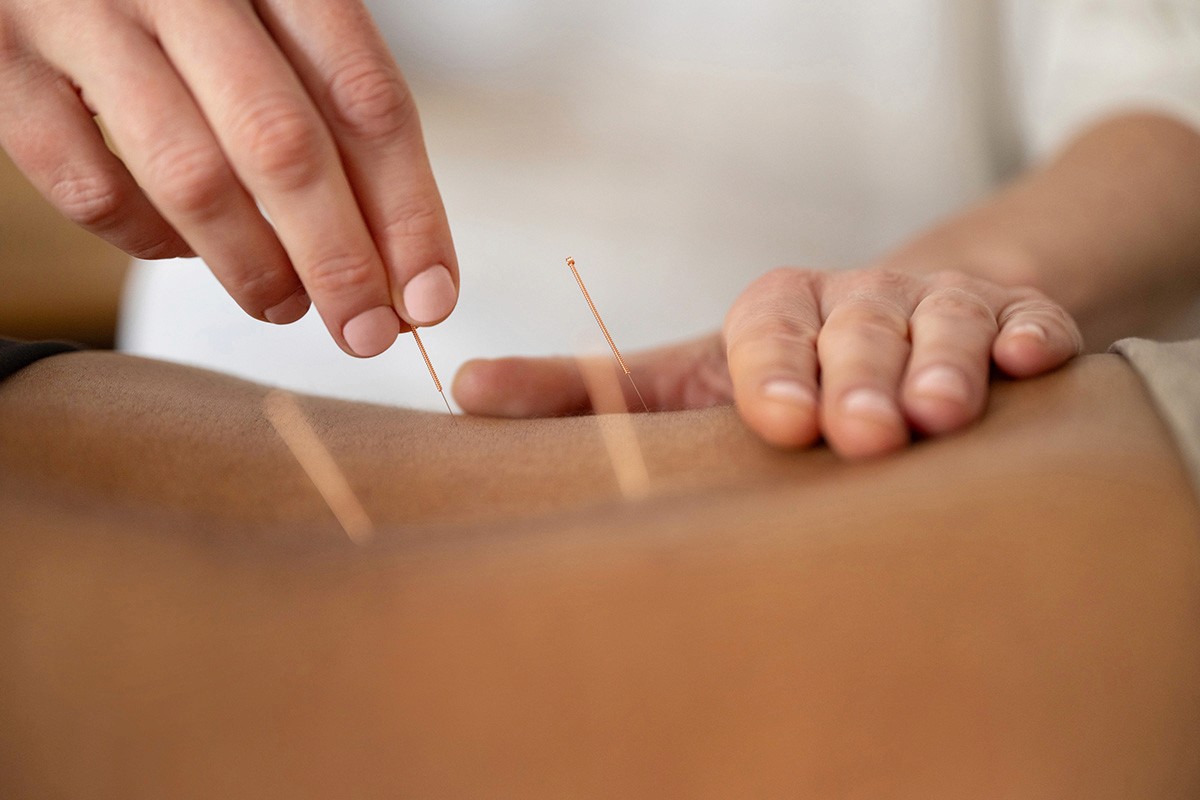 A gentle acupuncture treatment in progress, showing Ruth Fenton’s hand resting on the patient to ensure comfort during needle placement.