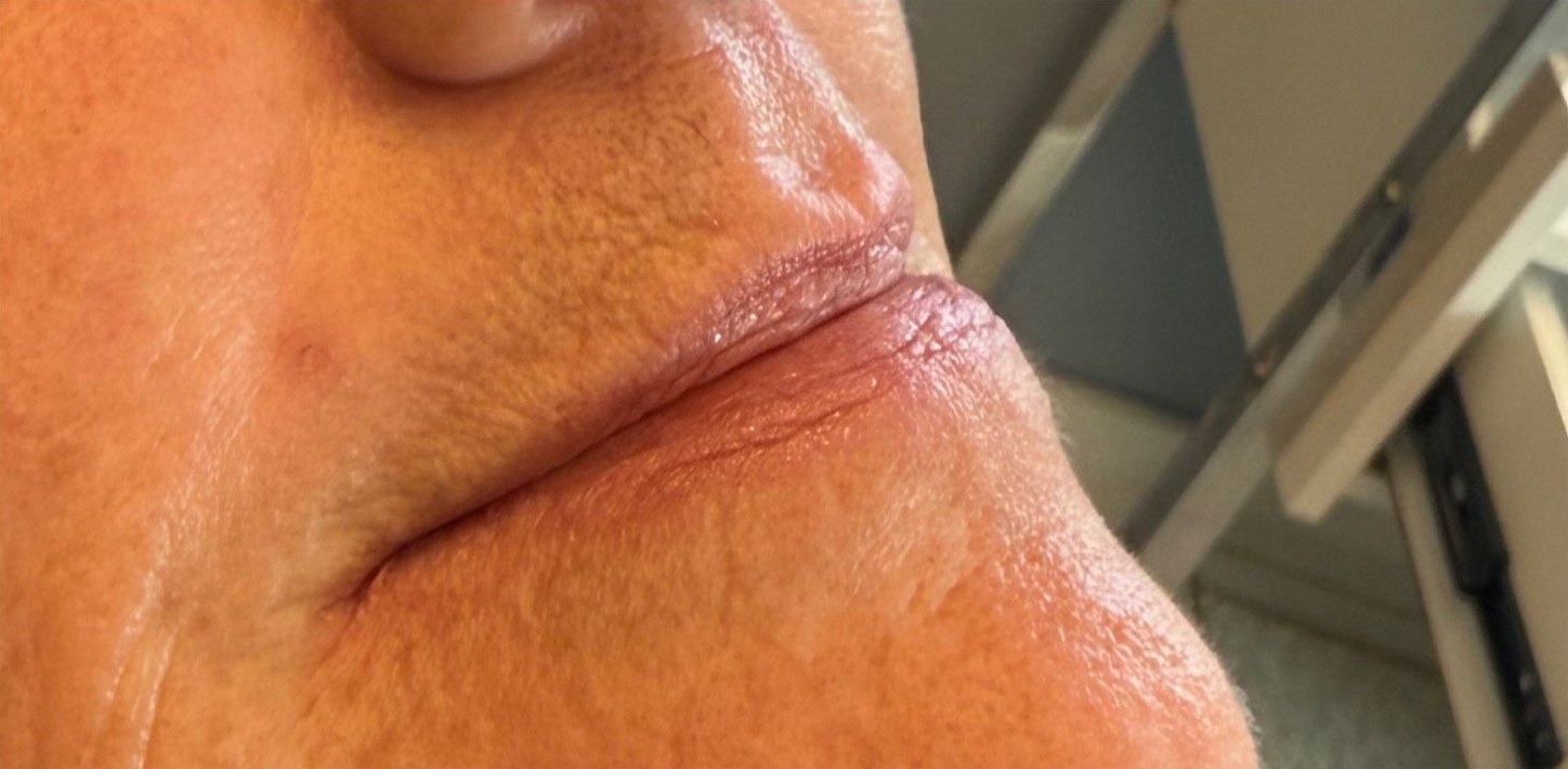 Before: close-up of lips.