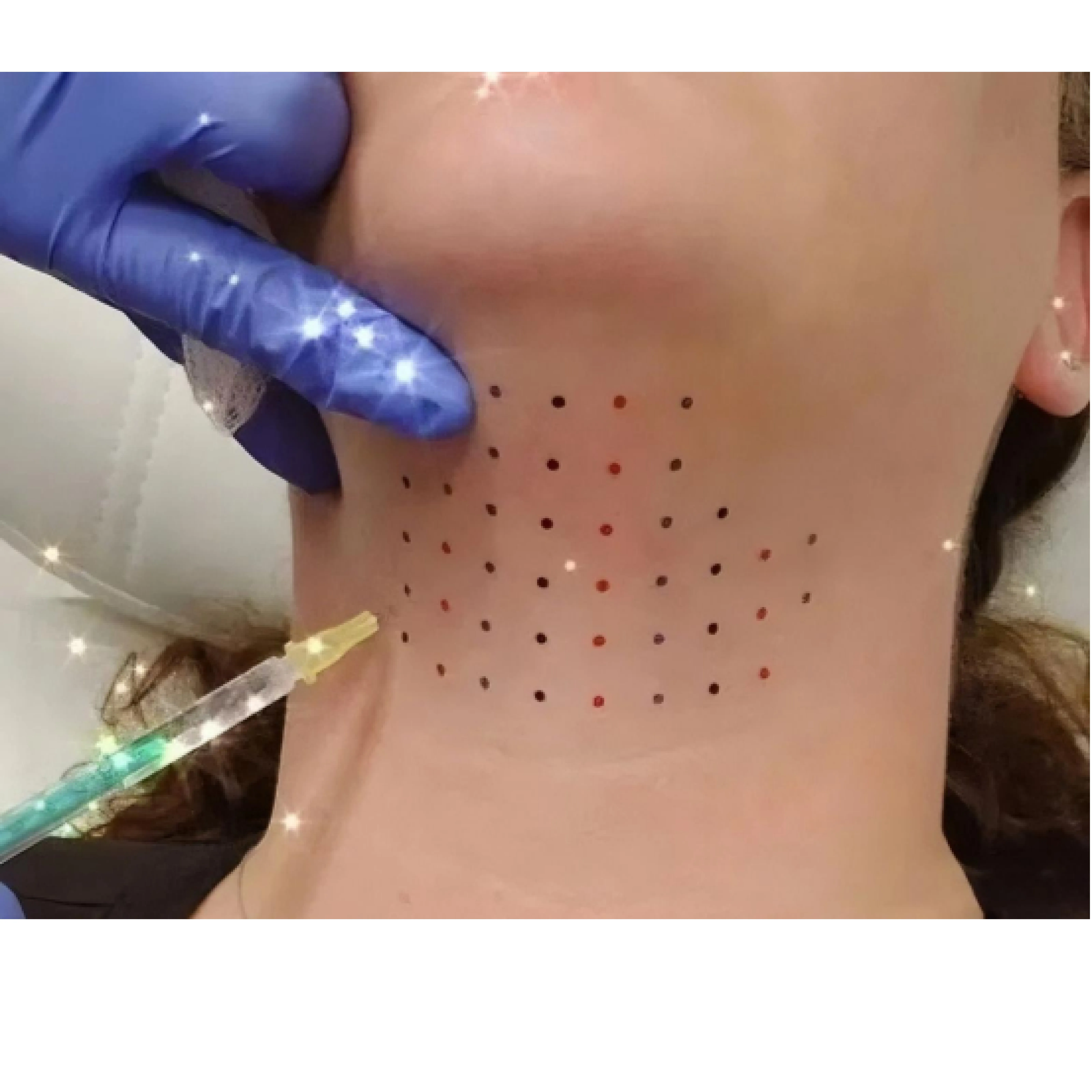 Deoxycholic Acid injectable solution for Mandibular region