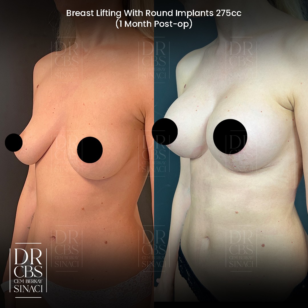 mastopexy-augmentation before after oblique view