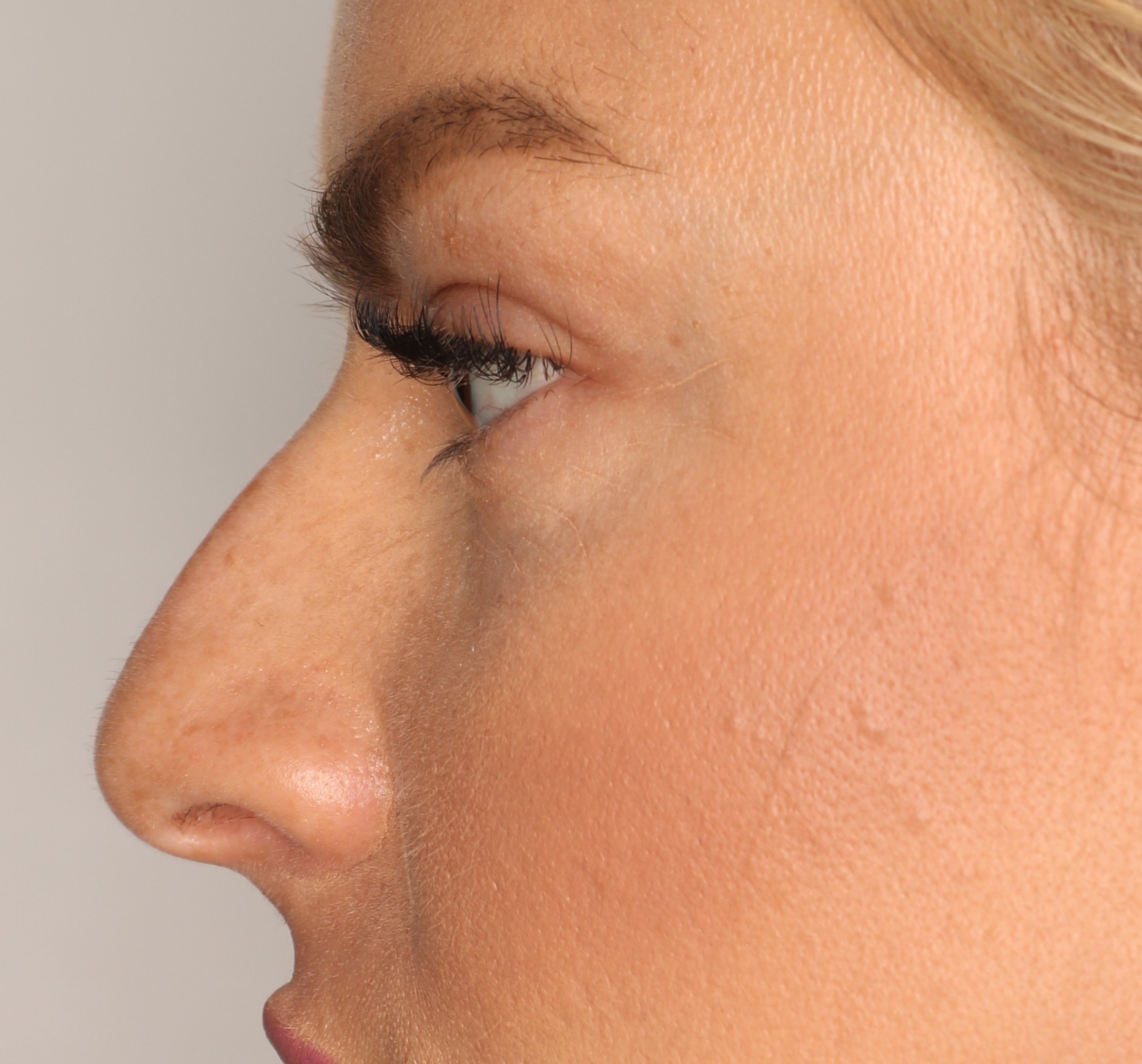 Korekta nosa - przed