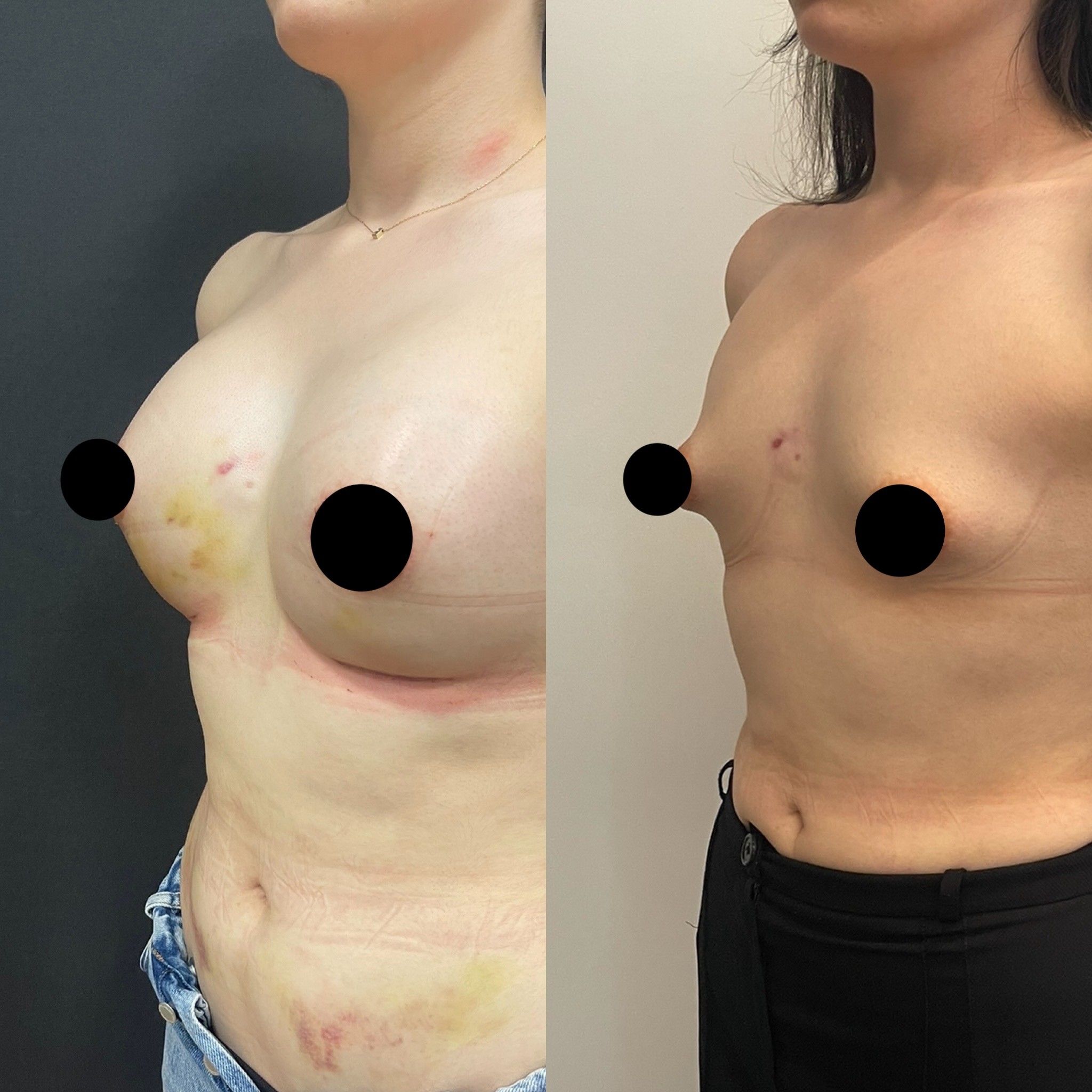 tuberous breast correction before after oblique view 5 days