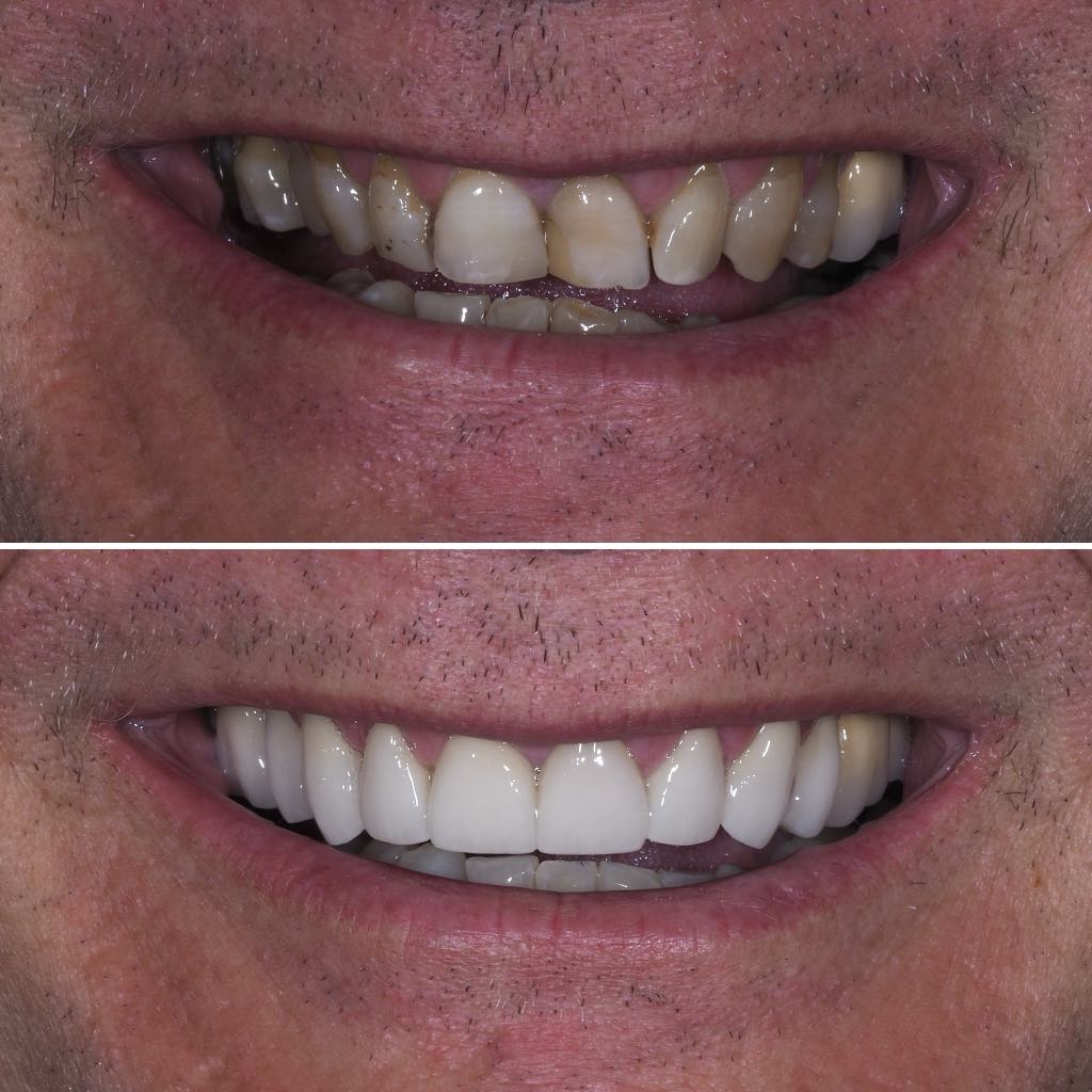 Before & After