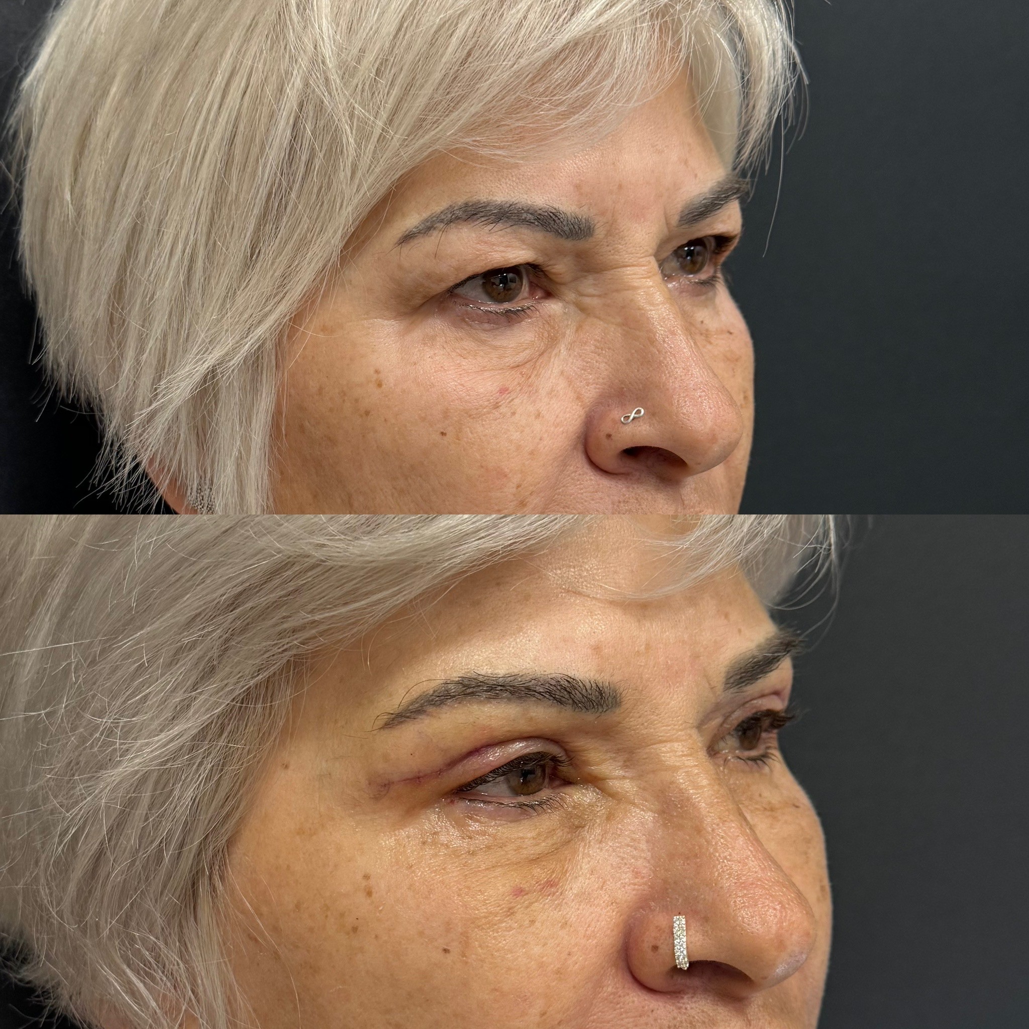 6 days upper blepharoplasty result right oblique view