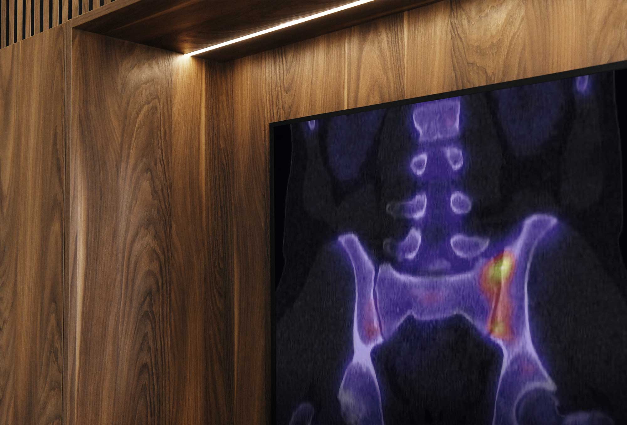 Iliosakralgelenk-Syndrom / ISG-Syndrom