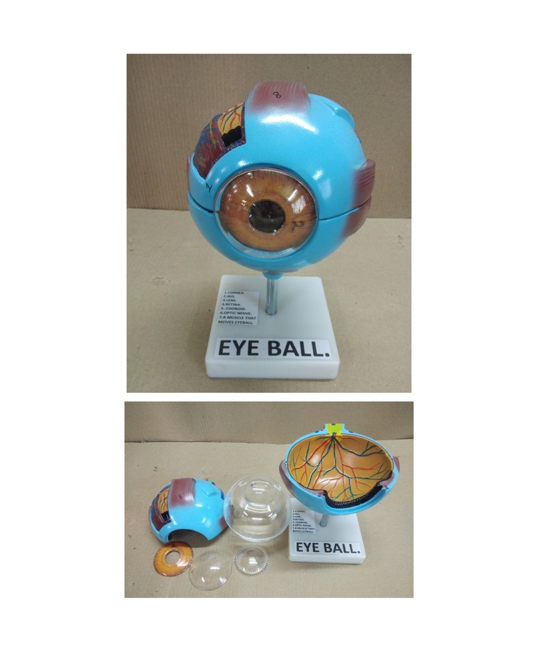 Enlarged Eyeball