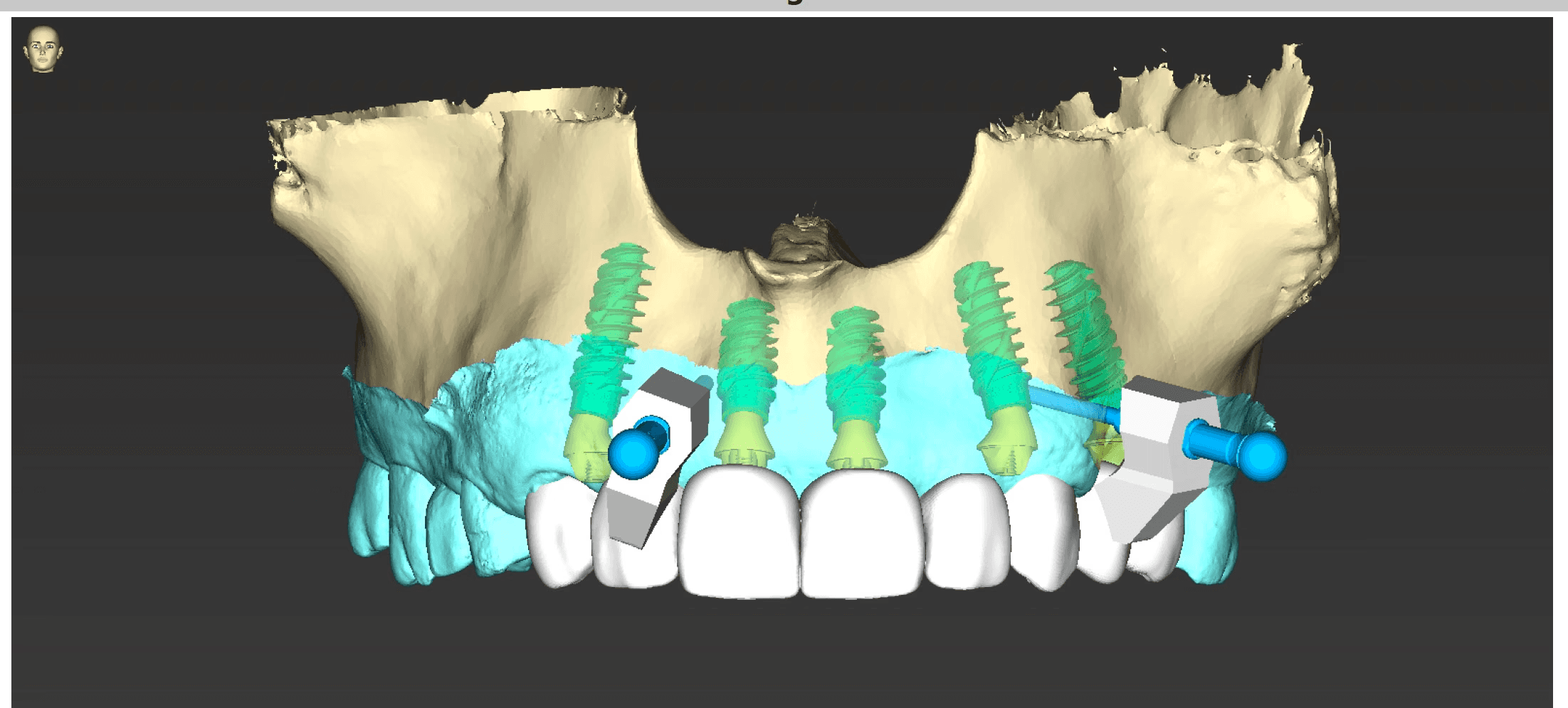 A digital rendering of dental implants and screws in a jawbone model, illustrating complex maxillary prosthodontic procedures at Oakville Dental Implant Studio.