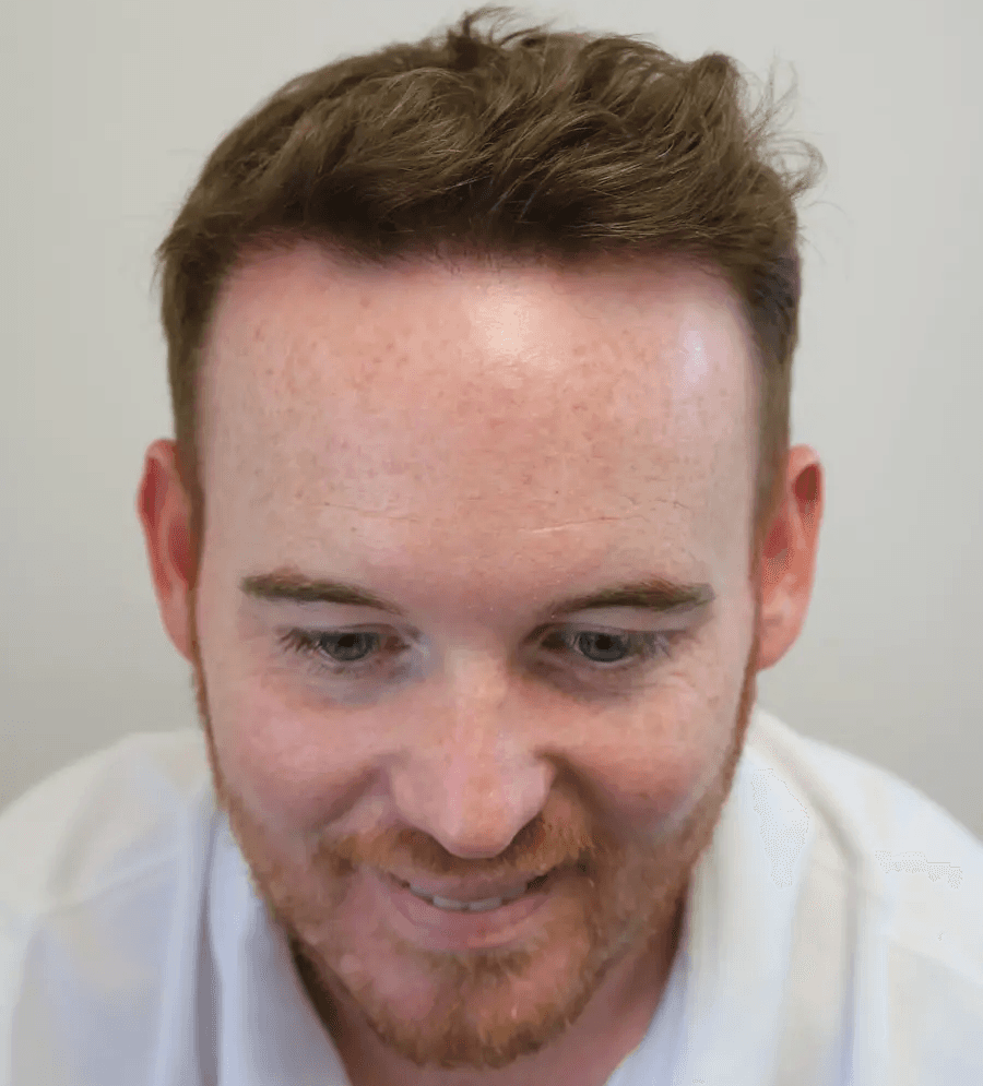 After hair transplant – Ross's FUE Hair Transplant