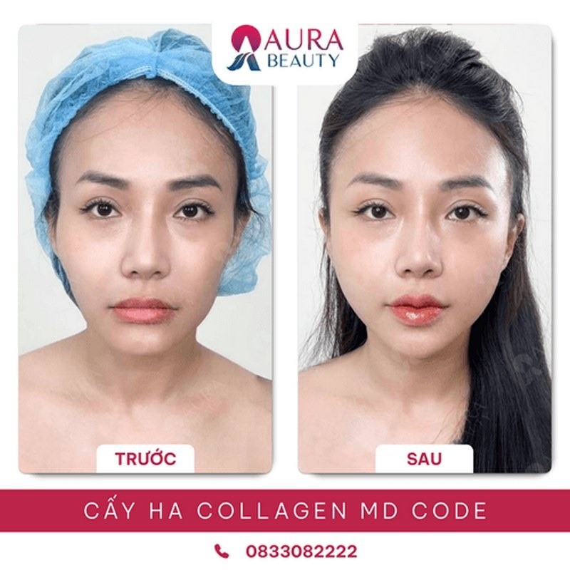 Kết quả tiêm Ha Collagen tại Thẩm mỹ viện Aura