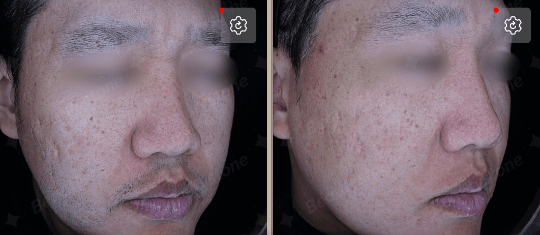 남자제모는젠틀맥스프로플러스를 이용해야 효과적입니다.