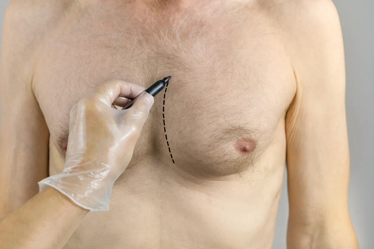 Profissional marcando o tórax masculino antes de procedimento para ginecomastia