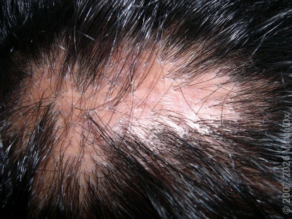 Lichen Planopilaris and Fibrosing Alopecia in a Pattern Distribution (FAPD) — image from NorCal Hair Doctor™'s existing website