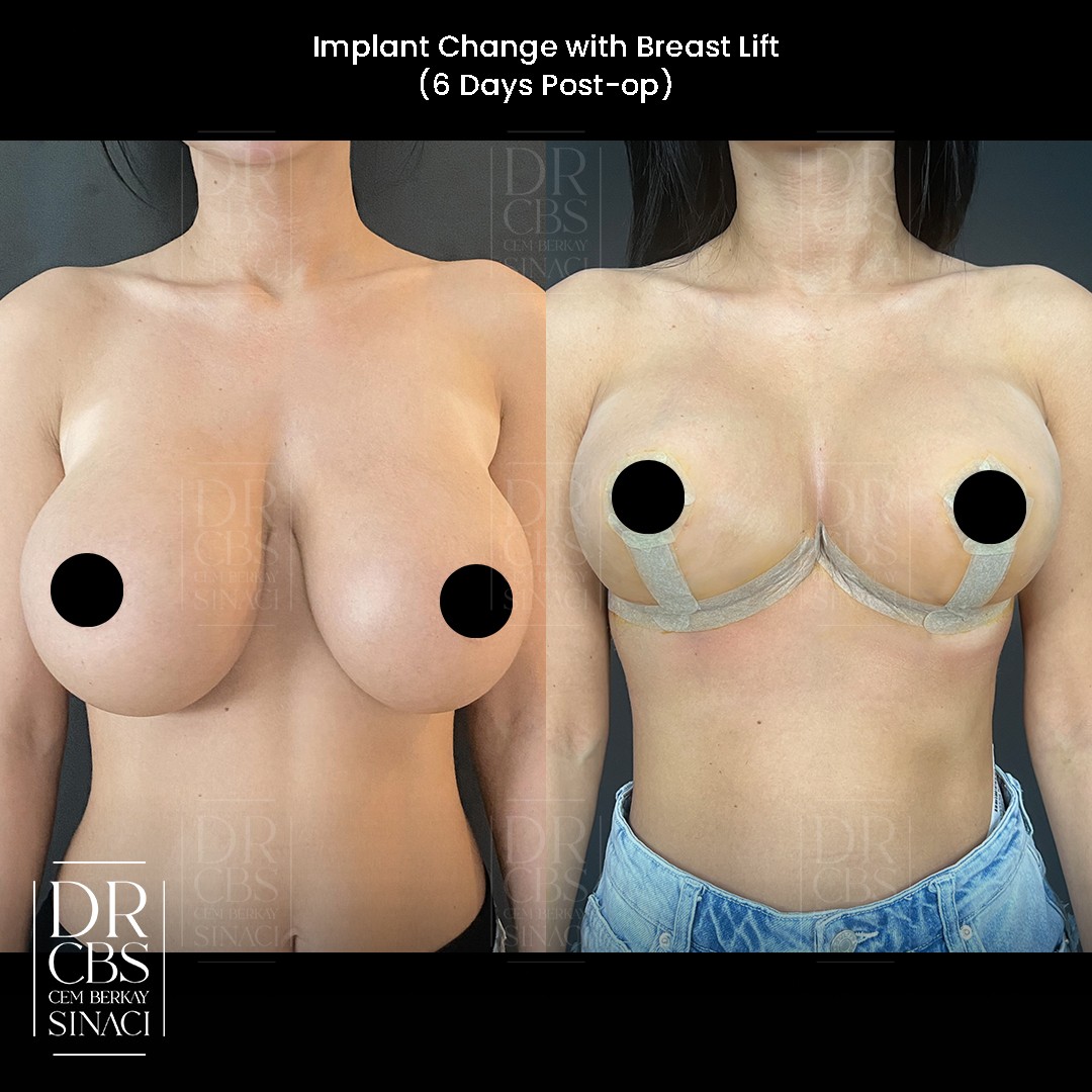 breast implant change with breast lift 6 days post-operative before after front view2