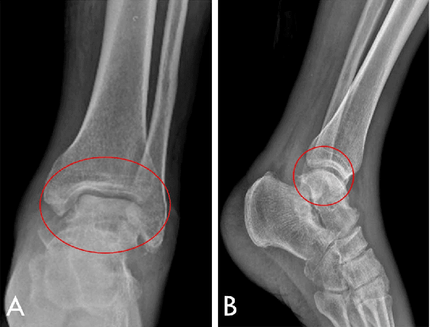 x-ray for arthritis of the foot & ankle