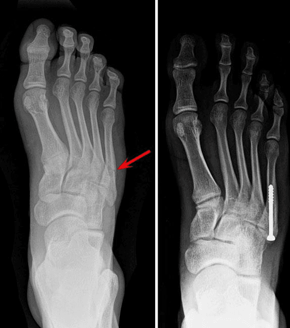 X-ray for Toe & Forefoot Fracture