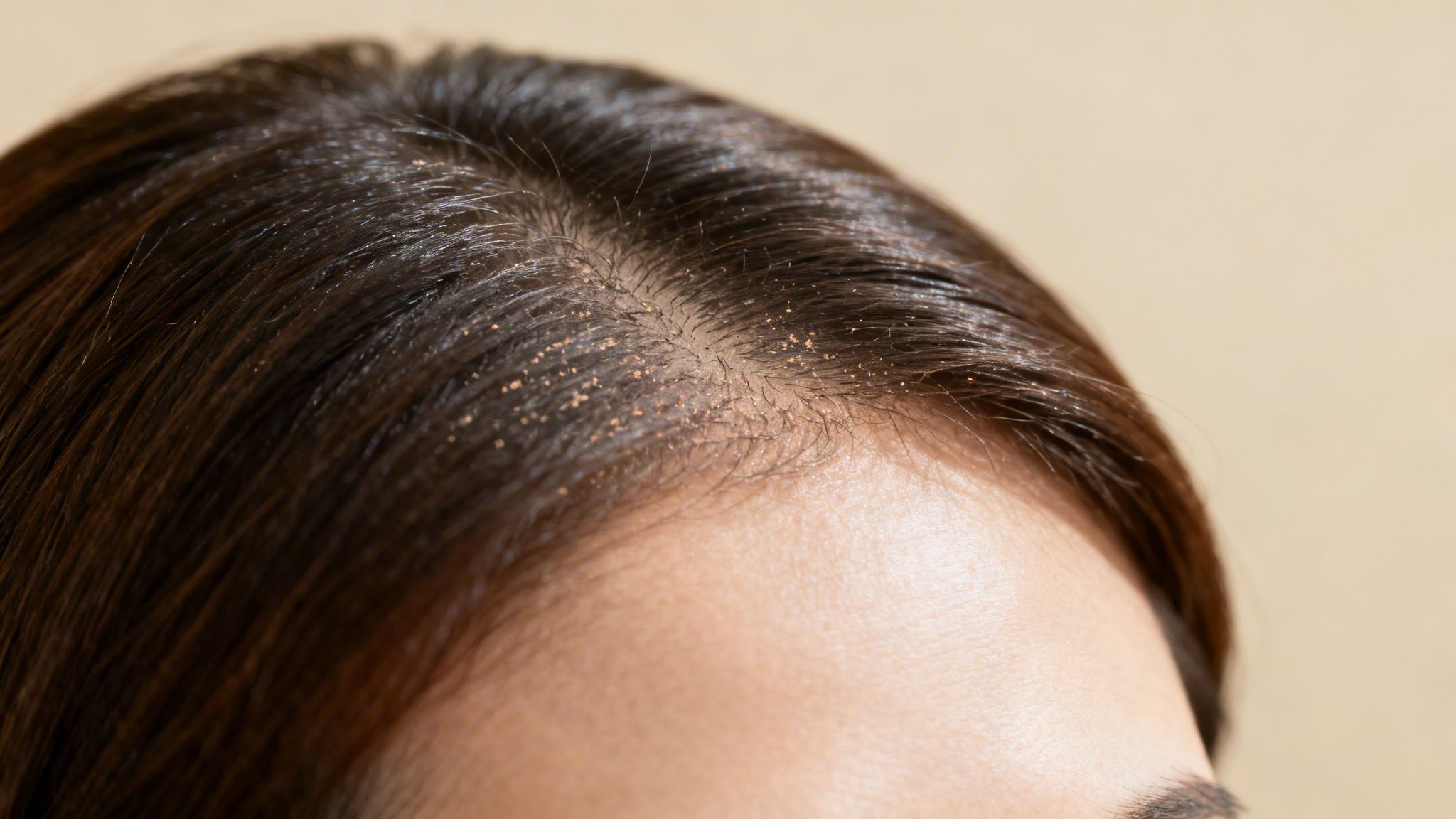 Close-up of a person's scalp with dark hair, showing visible dry skin or dandruff flakes.