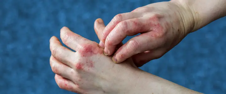 Tiny blisters or peeling on palms, sides of fingers, or soles