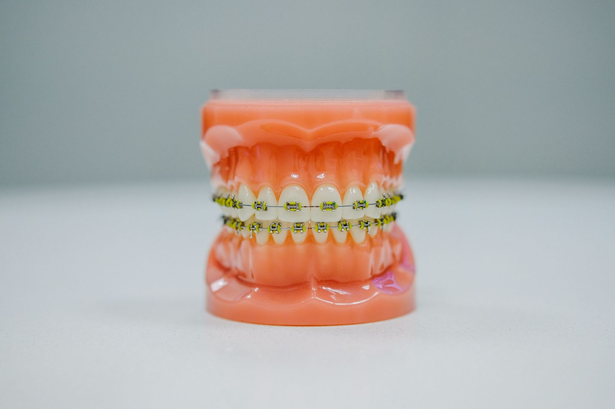 Metal Vs Ceramic Braces: Key Differences&nbsp;