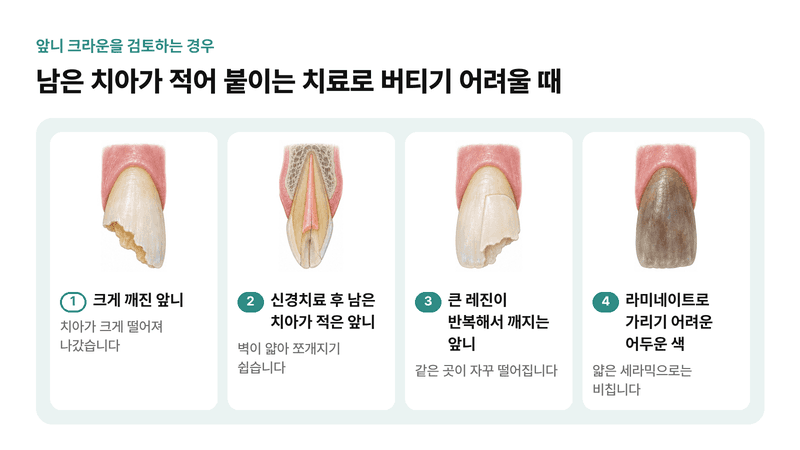 크게 깨진 앞니, 신경치료 후 남은 치아가 적은 앞니, 큰 레진이 반복해서 깨지는 앞니, 라미네이트로 가리기 어려운 어두운 색까지 앞니 크라운을 검토하는 네 가지 경우를 그린 일러스트