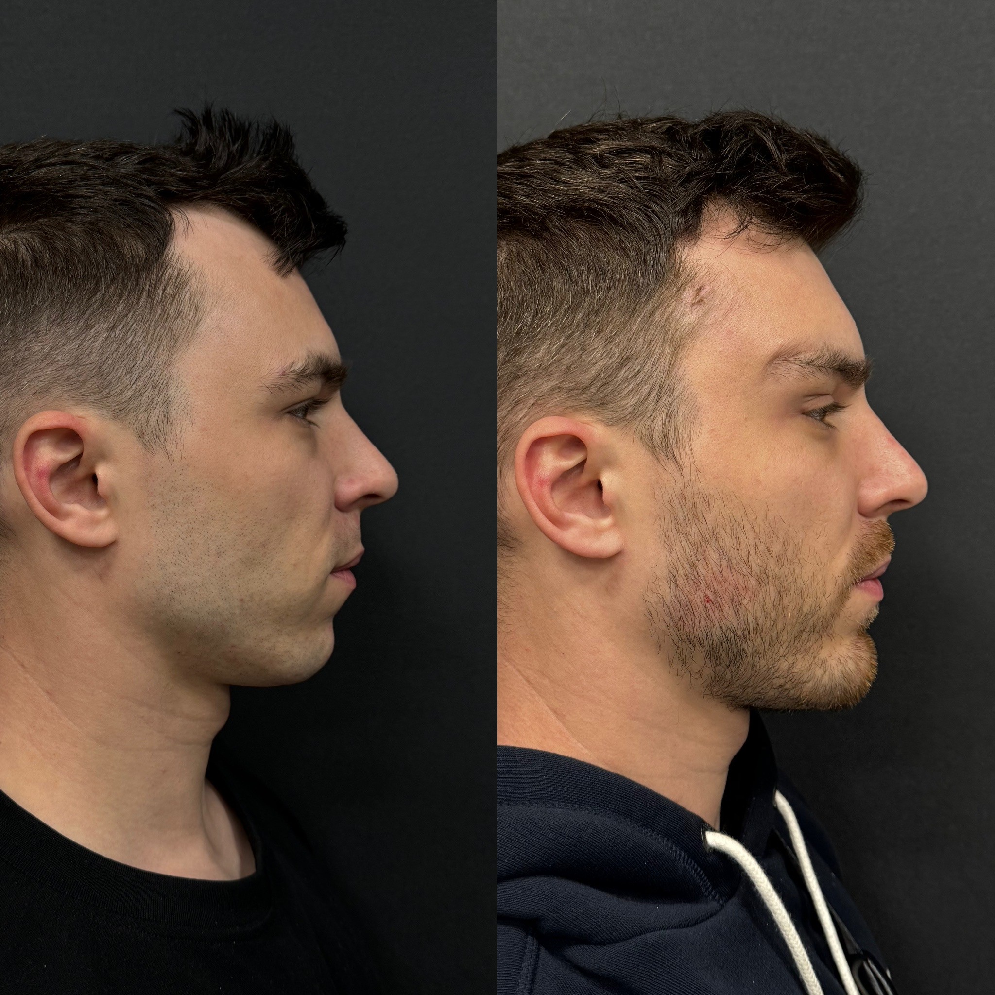 chin implant result before after 1 week side view