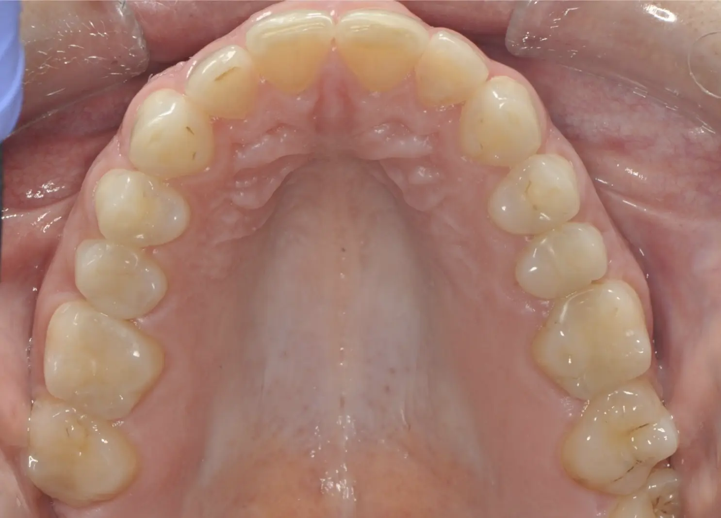 Before and after definitive ceramic restorations (crowns, veneers)