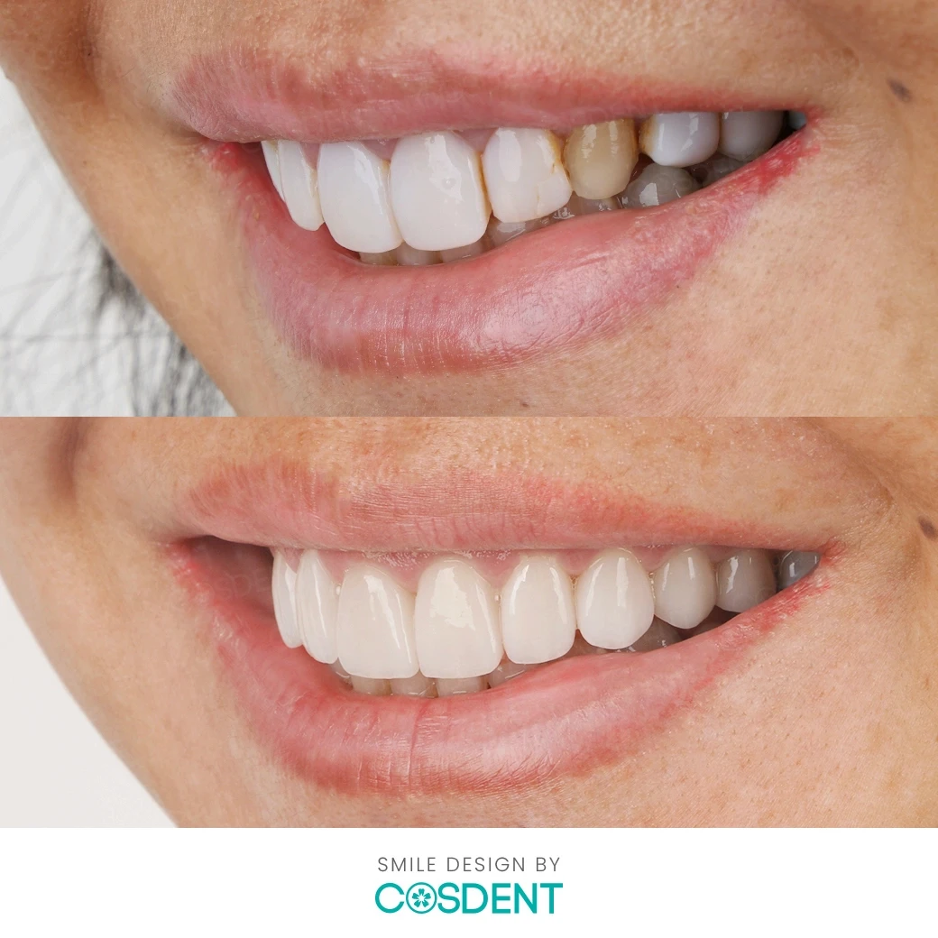 รีวิวออกแบบรอยยิ้ม ที่ cosdent smile design