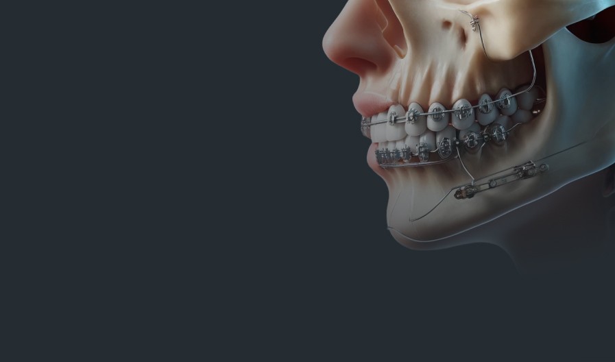 Orthognathic (jaw) Surgery