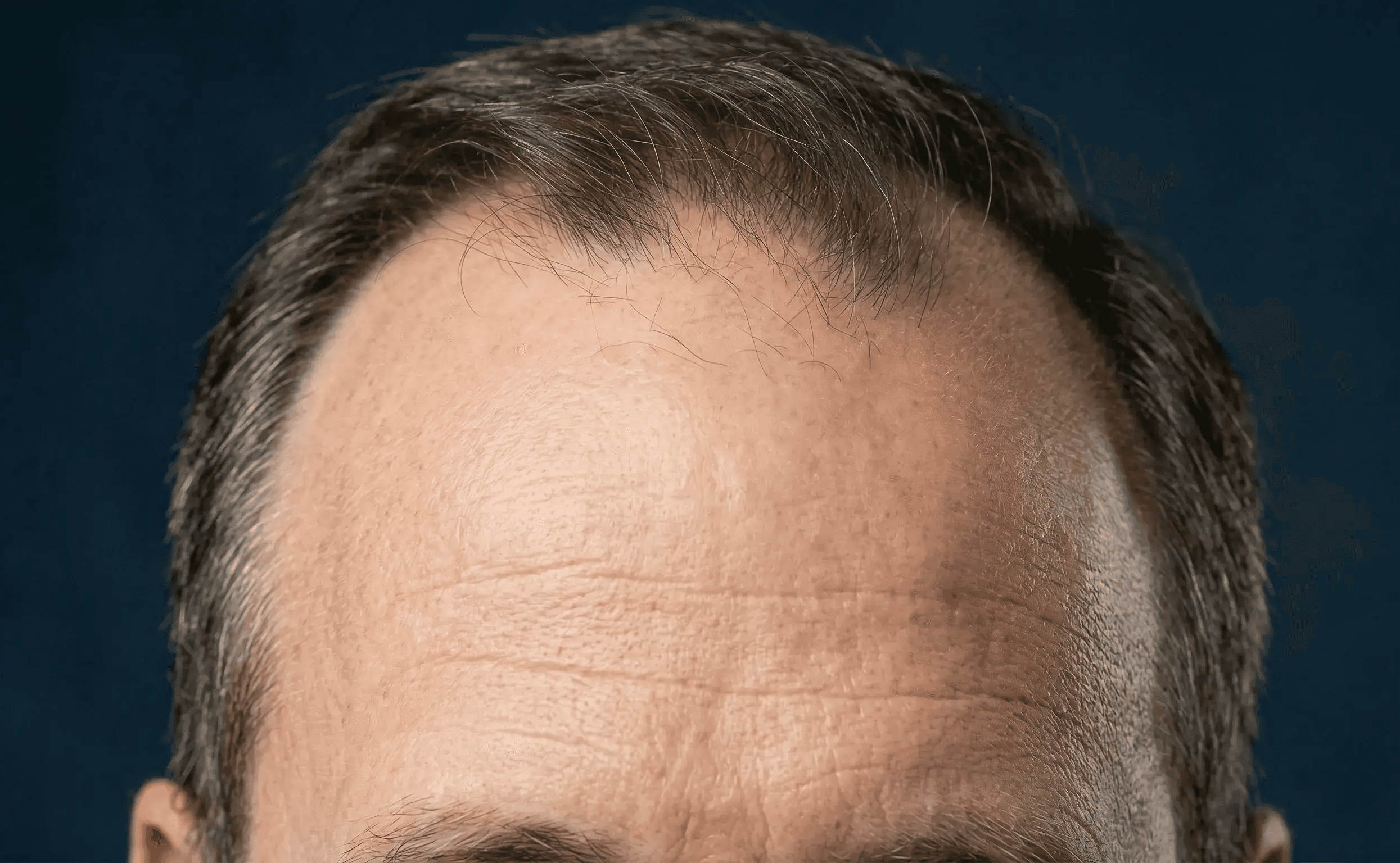A middle aged man with receding hairline and thinning hair