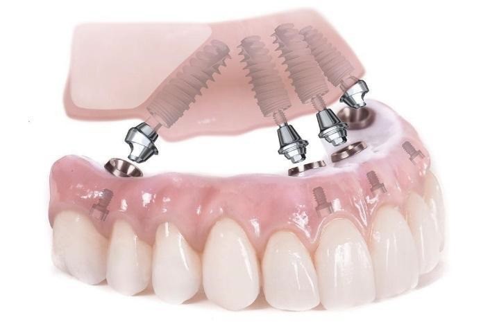 Fogászati implantátum (műgyökér beültetés)