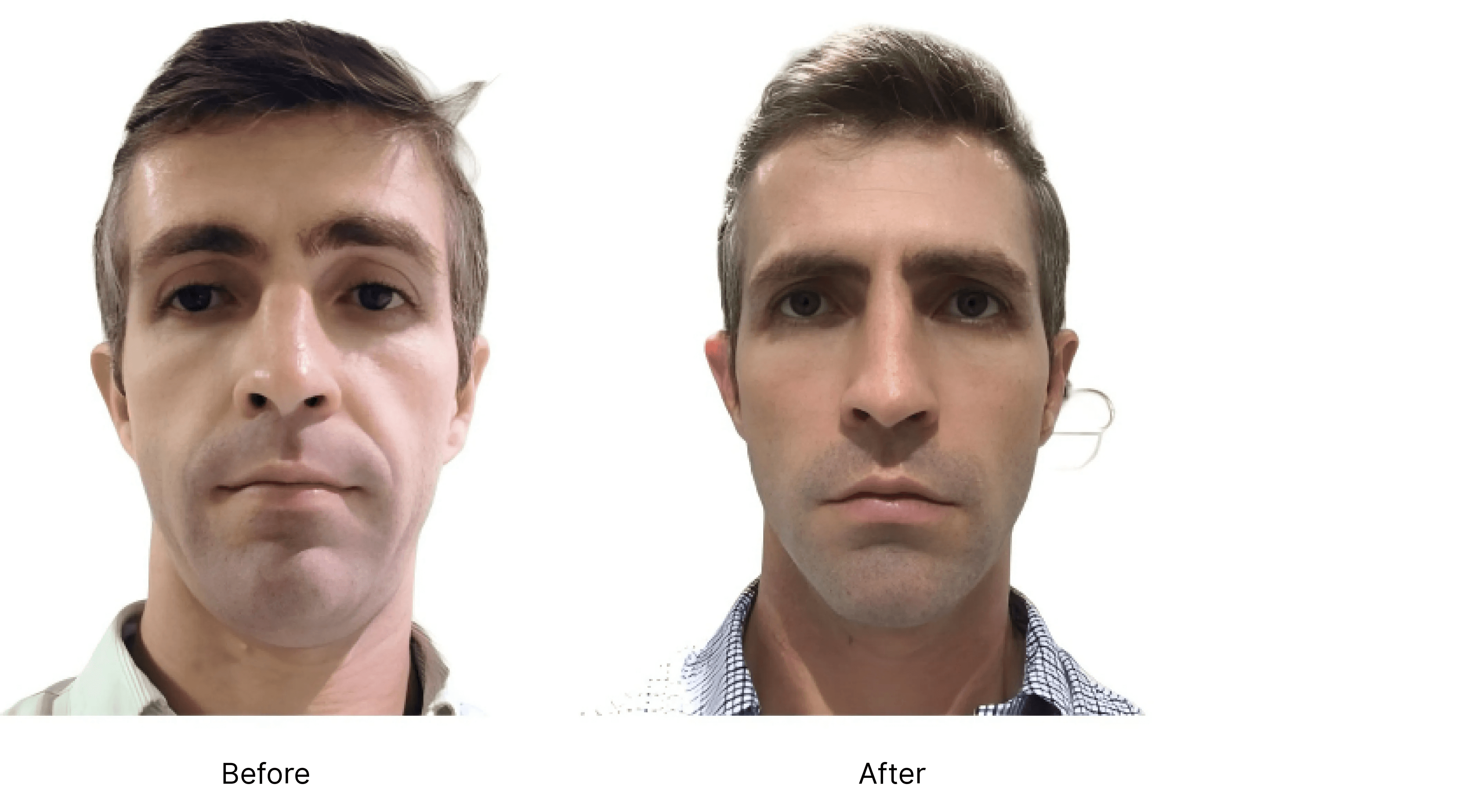 Rveiling ®HA-CaHA before & after Aowita