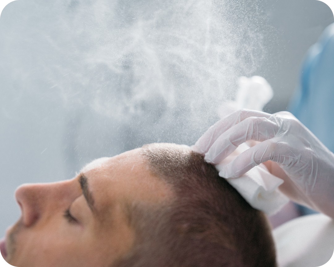 Beard Transplant Procedure