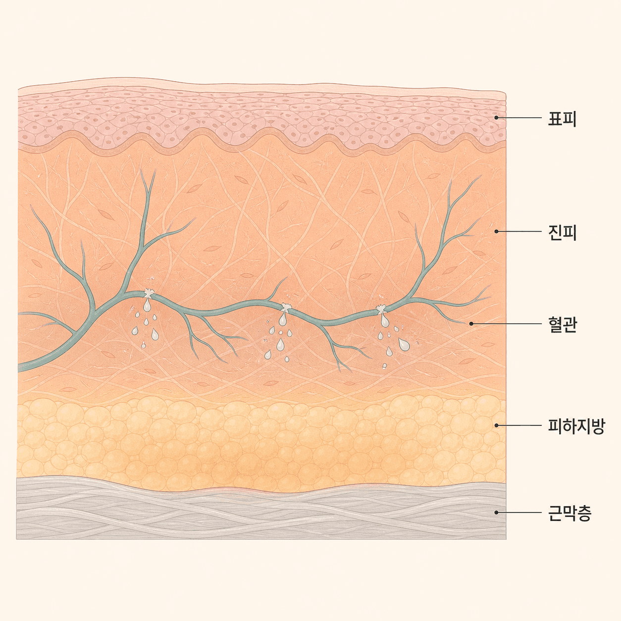 열이 닿는 층과 붓기가 생기는 자리